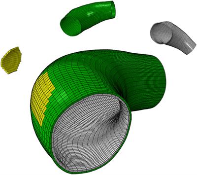 Computational Study of Growth and Remodeling in Ascending Thoracic Aortic Aneurysms Considering Variations of Smooth Muscle Cell <mark class="highlighted">Basal Tone</mark>